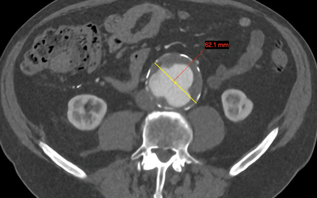 Abdominal Aortic Aneurysm (AAA) Screening