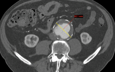 Abdominal Aortic Aneurysm (AAA) Screening